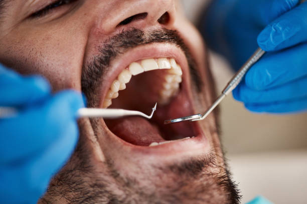 Best Emergency Wisdom Teeth Removal in Wakefield, KS